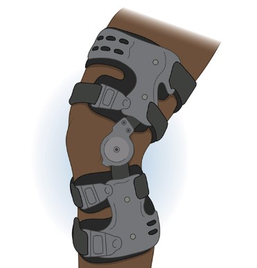 When Should a Knee Brace Enter the Conversation